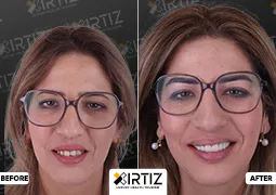 Turkey Teeth Pictures All-On-6 Implant