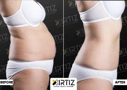 Obesity Treatment in Turkey