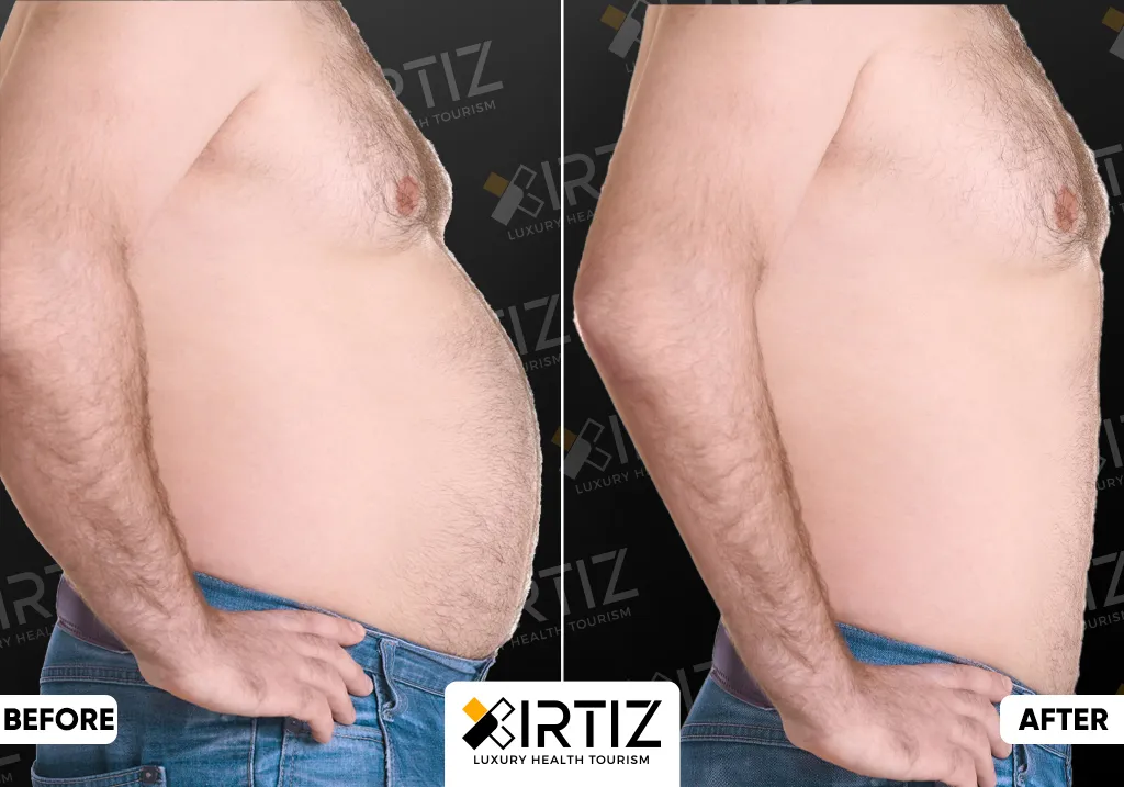 Obesity Treatment in Turkey