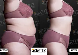 Obesity Treatment in Turkey