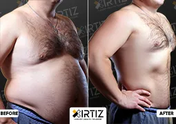 Obesity Treatment in Turkey