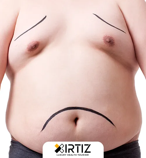 Obesity Treatments in Turkey